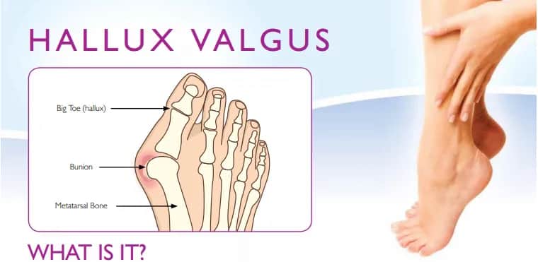 Haluksy: Od czego powstają? Poznaj 7 kluczowych przyczyn!