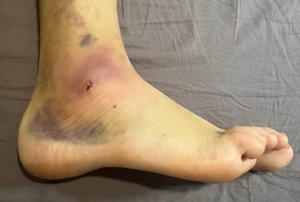 Skręcona kostka? Szybka pomoc, skuteczne leczenie i powrót do sprawności