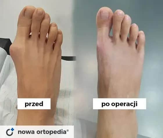 Po operacji haluksa: Kiedy wrócisz do ulubionych butów?