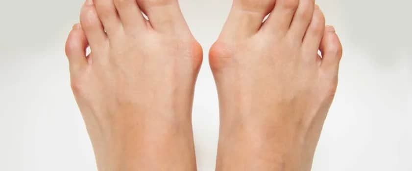 Dlaczego masz haluksy? Prawdziwe przyczyny i skuteczna profilaktyka