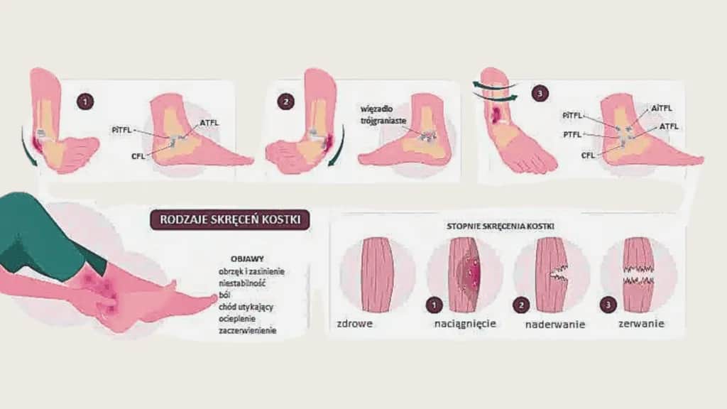 Skręcona kostka: Ile się goi? Pełny plan powrotu do sprawności