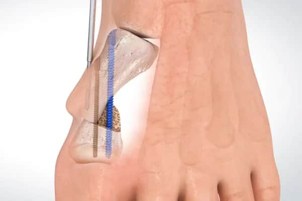 Znieczulenie do operacji haluksa: Wybierz komfort i bezpieczeństwo